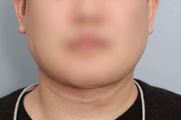 이중턱재수술_두꺼비목성형 1단계+귀밑샘지방흡입+목지방흡입 After