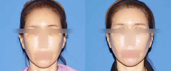 이마거상 + 중안면부거상 전후 사진