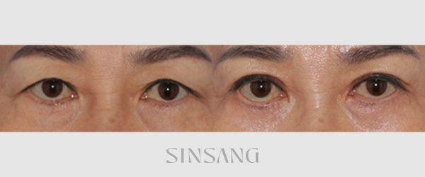 상안검 + 하안검 전후 사진
