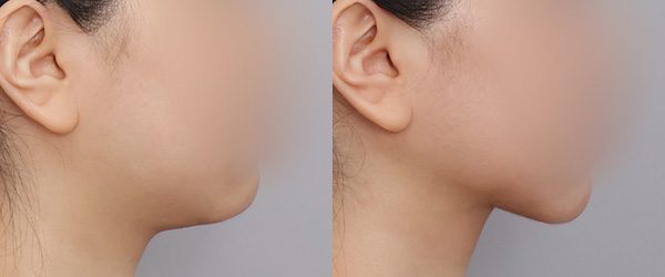 이중턱 흡묶고 전후 사진