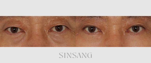 하안검 + 눈썹하거상 전후 사진