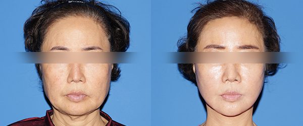 풀거상 + 목거상 + 심부볼 제거 + 근육묶기 전후 사진