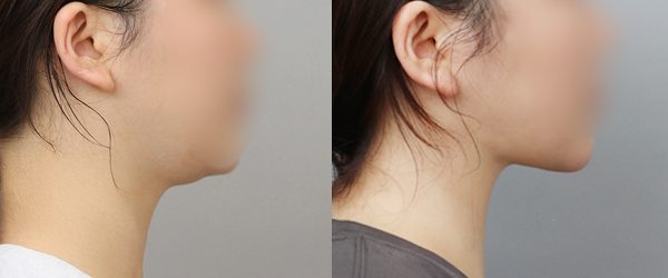 이중턱 지방흡입 + 근육묶기 전후 사진