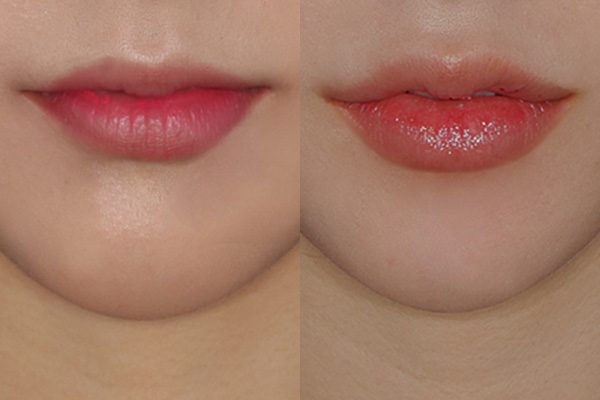 입술필러 전후 사진