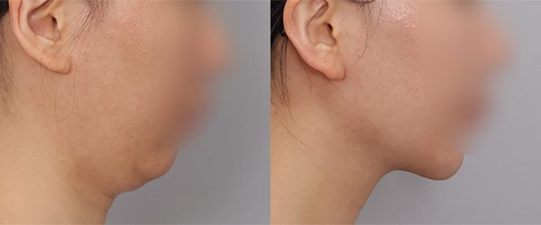 이중턱 지방흡입 + 근육묶기 전후 사진