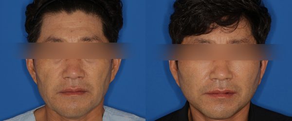 안면거상 + 풀페이스 지방이식 전후 사진