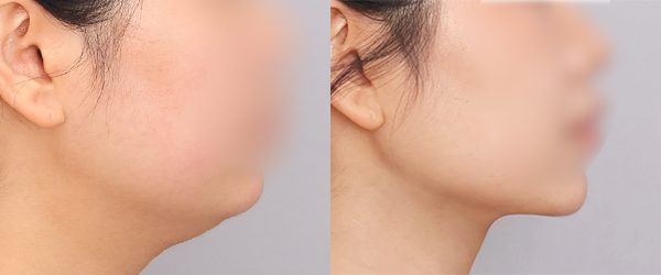 이중턱 지방흡입 + 근육묶기 전후 사진