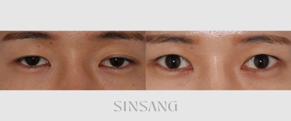 앞트임+뒷트임+절개+눈매교정 재수술 전후 사진