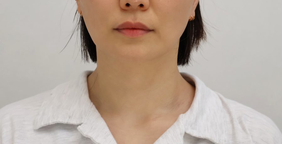목주름 After