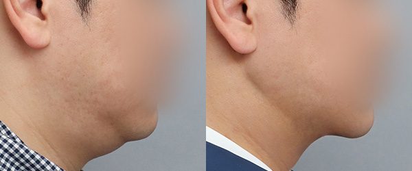 이중턱 흡묶고 전후 사진