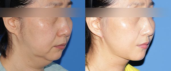 풀거상 + 이중턱 흡묶고 + 두꺼비 목성형 전후 사진