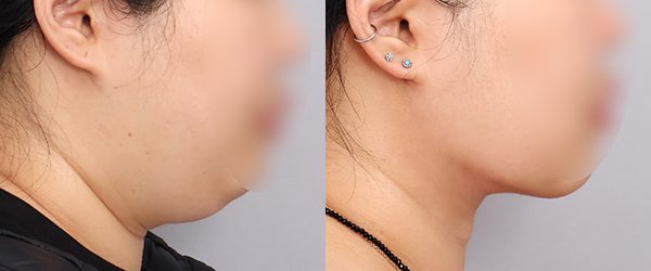 이중턱재수술_두꺼비목성형 1단계+이복근교정+목지방흡입 전후 사진