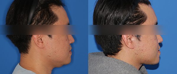 미니거상(상+중) + 이중턱 흡묶고 전후 사진