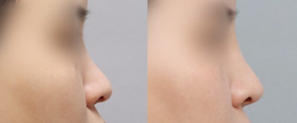 콧대 + 코끝 전후 사진