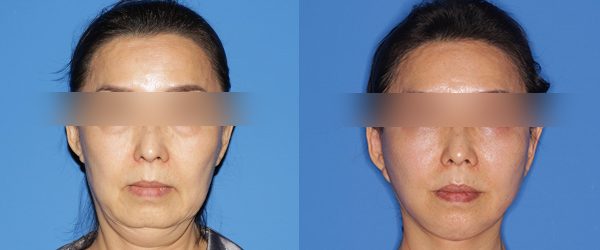 풀거상 + 목거상 전후 사진