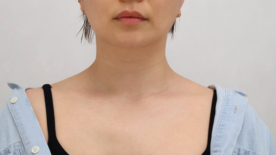 목주름 Before