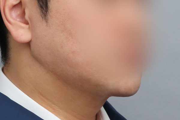 이중턱 흡묶고 After