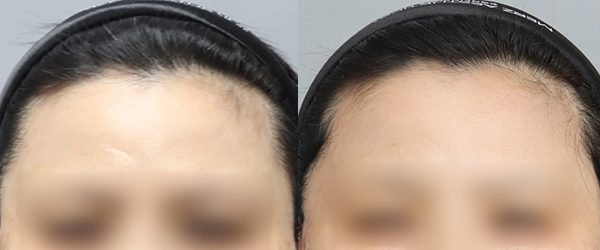 흉터치료 전후 사진