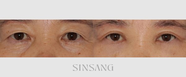 상안검 + 하안검 + 눈밑지방재배치 + 눈썹하거상 전후 사진