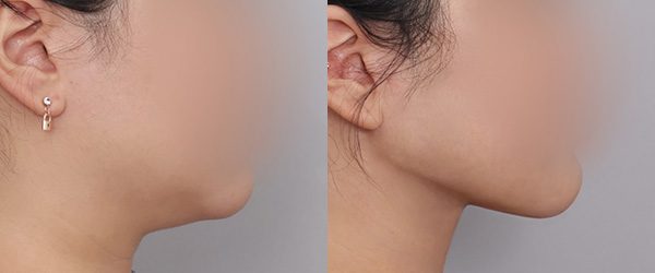 이중턱 흡묶고 전후 사진