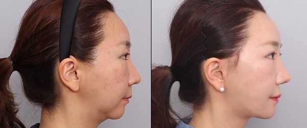 앞턱전진+안면거상+두꺼비목성형 2단계+이복근교정+상안검+코성형+얼굴지방흡입 전후 사진