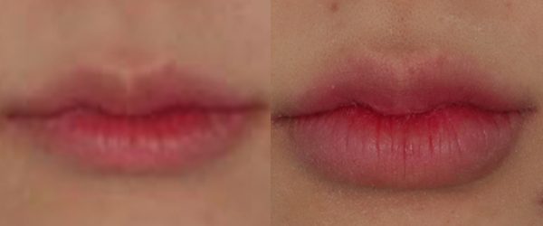 입술필러 전후 사진