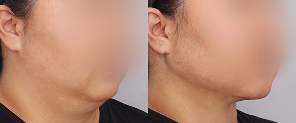 이중턱 흡묶고 전후 사진