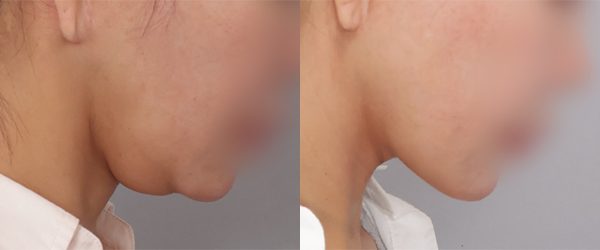 이중턱 지방흡입 + 근육묶기 전후 사진