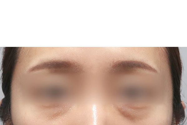 눈밑 지방 재배치 Before