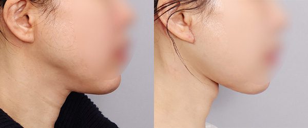 이중턱재수술_두꺼비목성형 2단계+이복근교정+목거상 전후 사진