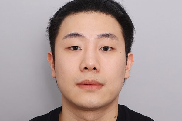 광대축소+사각턱축소+턱끝+두꺼비목성형 2단계+이복근교정+절개눈매교정+눈밑지방재배치+코성형 Before