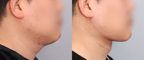 이중턱재수술_두꺼비목성형 1단계+귀밑샘지방흡입+목지방흡입 전후 사진