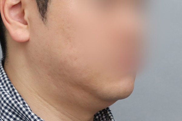 이중턱 흡묶고 Before