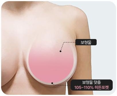 세이프티 포켓 도식 — 보형물과 보형물 맞춤 105~110% 히든포켓 표시