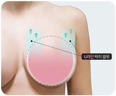 디테일한 박리 도식 — U라인 박리 범위 표시