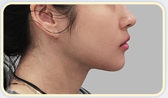 두꺼비목성형 전후 1 — AFTER 3M(옆모습)