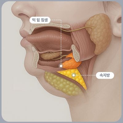 두꺼비목성형 2단계 — 턱 밑 침샘·속지방 표시 해부도