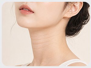 선천적인 목주름 — 목 가로주름 클로즈업
