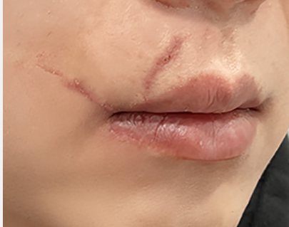 입가 흉터 Before