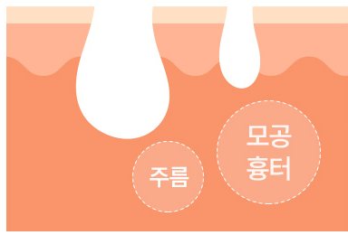 시술 전 피부 단면(주름·모공 흉터 표시)