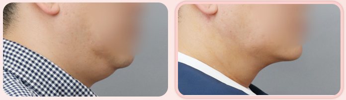 이중턱 흡묶고 전후 1(옆모습, BEFORE / AFTER 3M)