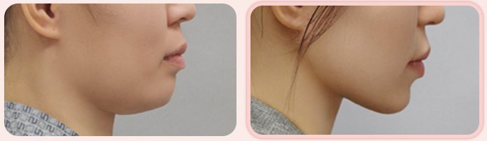 이중턱 흡묶고 전후 2(옆모습, BEFORE / AFTER 3M)