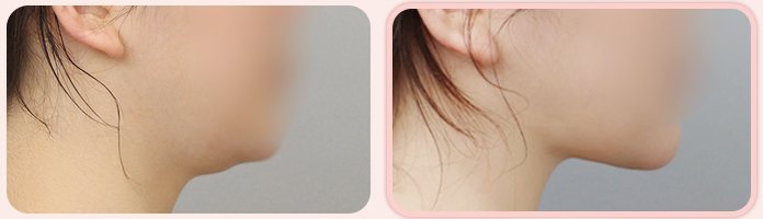 이중턱 흡묶고 전후 3(옆모습, BEFORE / AFTER 3M)