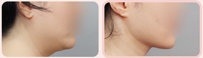 이중턱 흡묶고 전후 4(옆모습, BEFORE / AFTER 3M)