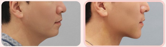 이중턱 흡묶고 전후 5(옆모습, BEFORE / AFTER 3M)