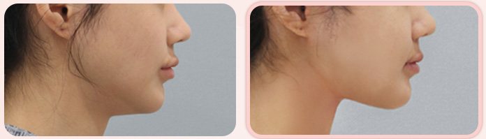 이중턱 흡묶고 전후 6(옆모습, BEFORE / AFTER 3M)