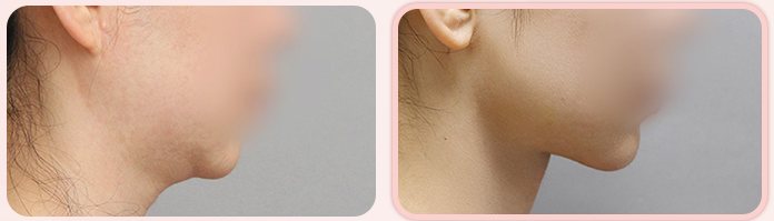 이중턱 흡묶고 전후 7(옆모습, BEFORE / AFTER 3M)
