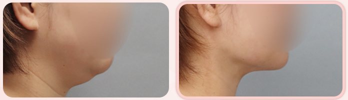 이중턱 흡묶고 전후 8(옆모습, BEFORE / AFTER 3M)