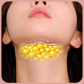 STEP 01 — 턱 아래 피하지방 표시(노란 지방 알갱이)