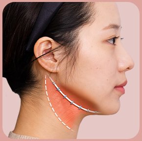 STEP 03 — 턱 아래~귀 밑 고정 실(해먹 형태) 도식, 옆모습